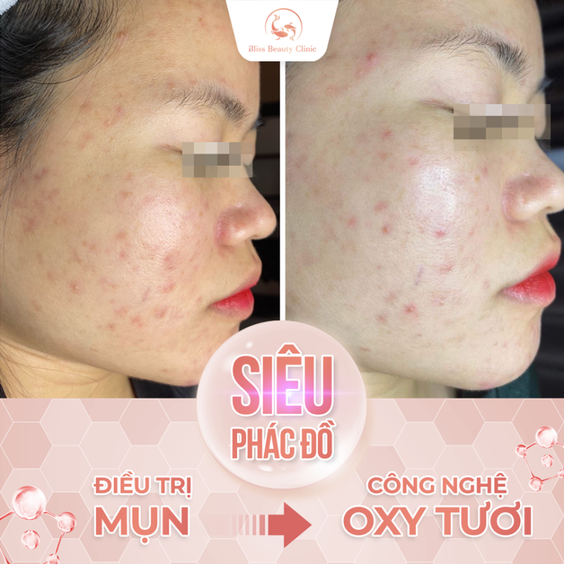 Địa điểm trị mụn giá rẻ tại Gò Vấp