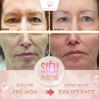 EXILIFT FACE TRẺ HÓA VÙNG NHĂN MẮT MÁ TRÊN
