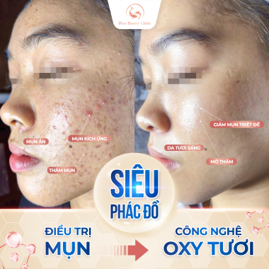 Điều Trị Mụn Công Nghệ Oxy Tươi Địa Điểm Trị Mụn Uy Tín Tại Thủ Đức