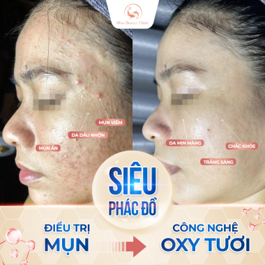 Điều Trị Mụn Công Nghệ Oxy Tươi Địa Điểm Trị Mụn Uy Tín Tại Thủ Đức