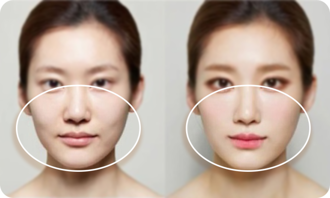 Filler Tạo Hình Má Baby