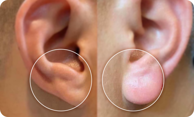 Filler tạo hình tai phật