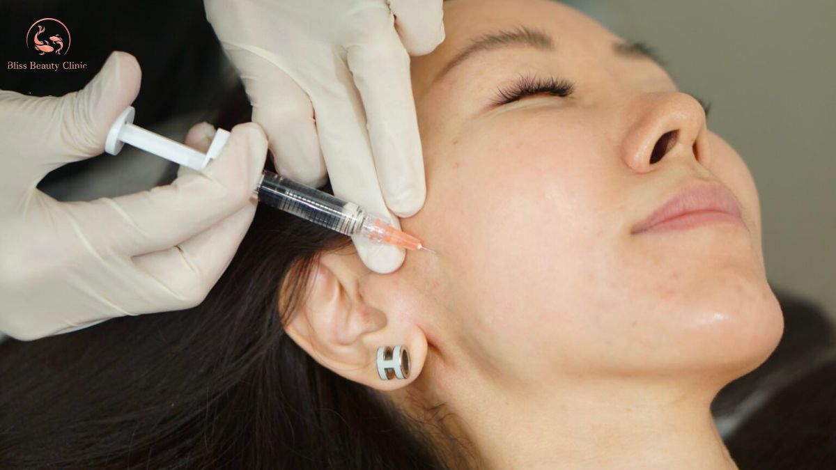 Kỹ thuật tiêm BAP 5 điểm