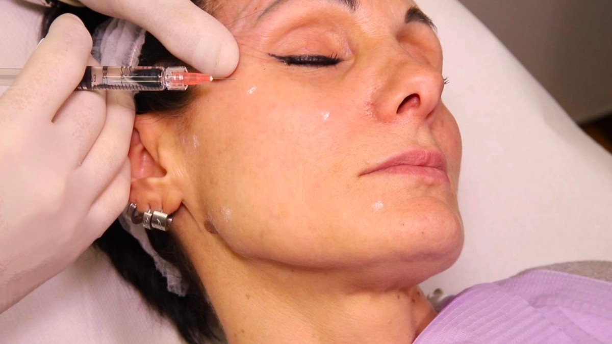 Kỹ thuật tiêm BAP 5 điểm