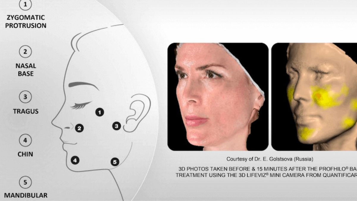 Kỹ thuật tiêm BAP 5 điểm