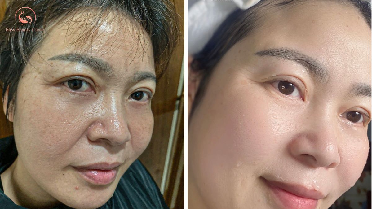 Kỹ thuật tiêm BAP 5 điểm