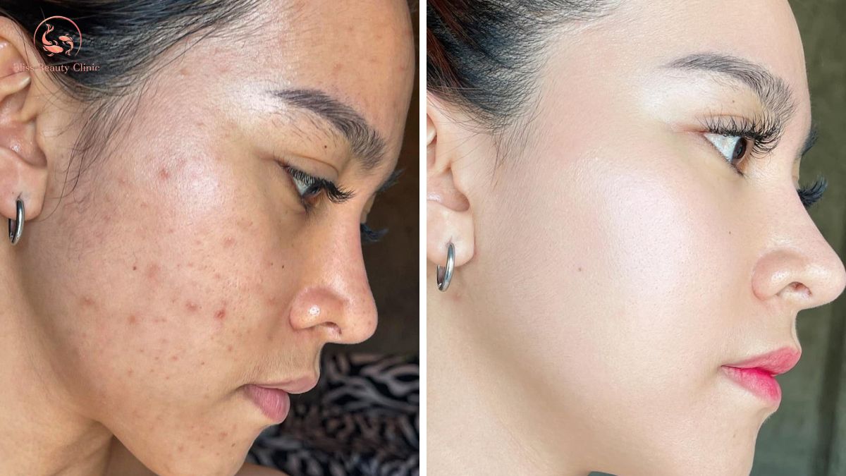 Kỹ thuật tiêm BAP 5 điểm