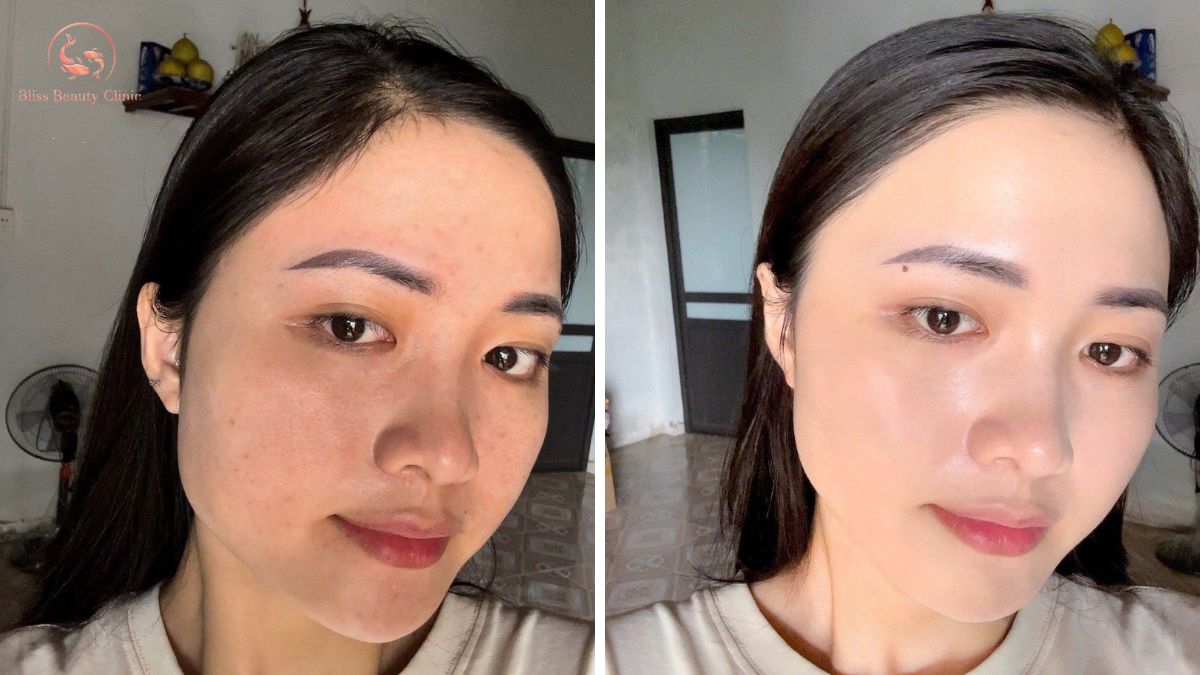 Kỹ thuật tiêm BAP 5 điểm