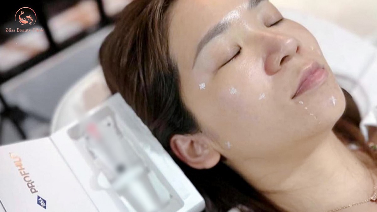 Kỹ thuật tiêm BAP 5 điểm