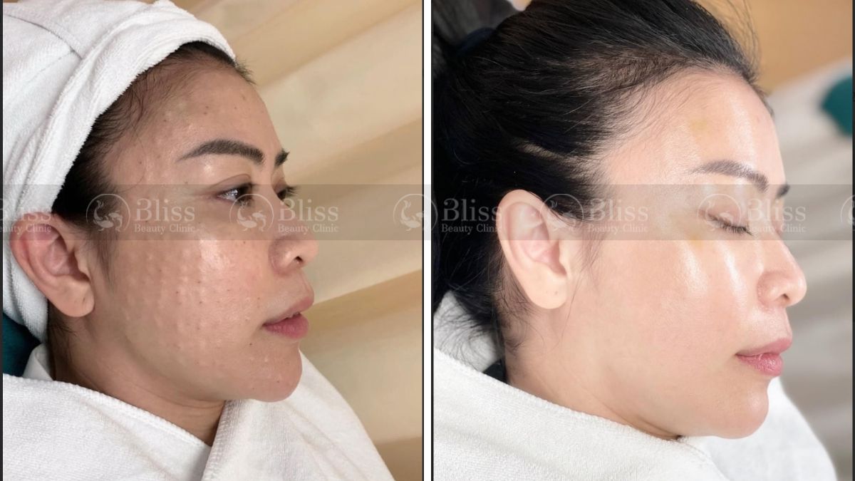 mesocell-extra-la-gi Tiêm meso