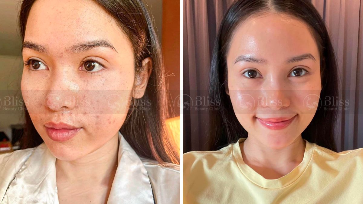 mesocell-extra-la-gi Tiêm meso