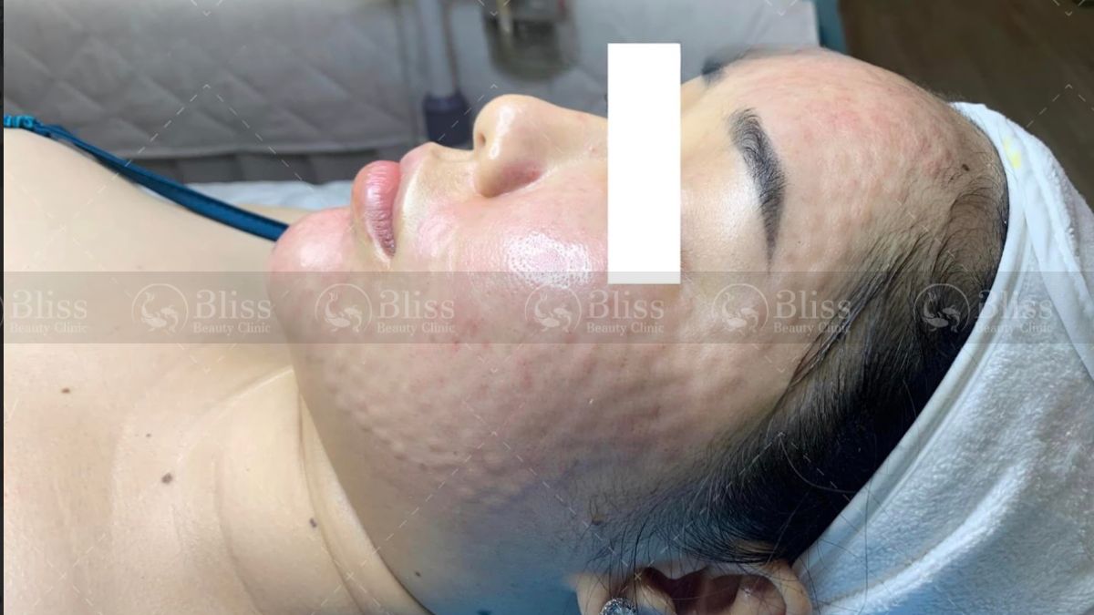 mesocell-extra-la-gi Tiêm meso