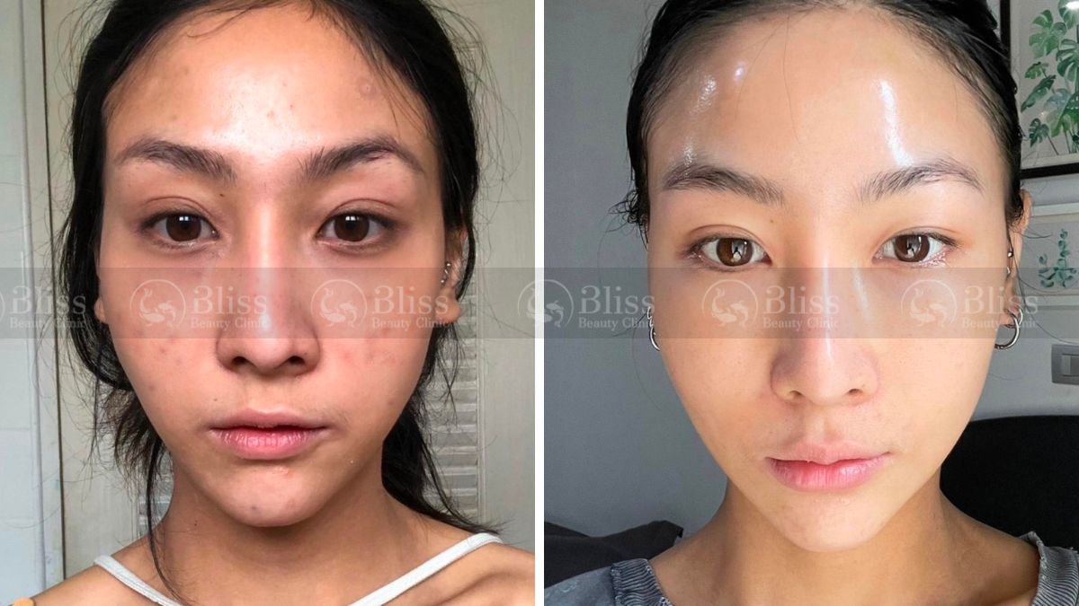 mesocell-extra-la-gi Tiêm meso 