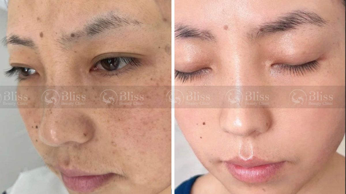 mesocell-extra-la-gi Tiêm meso