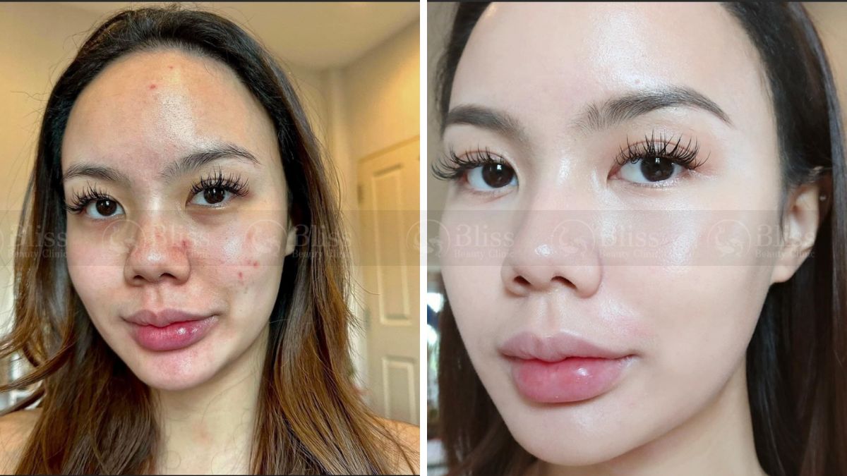 mesocell-extra-la-gi Tiêm meso