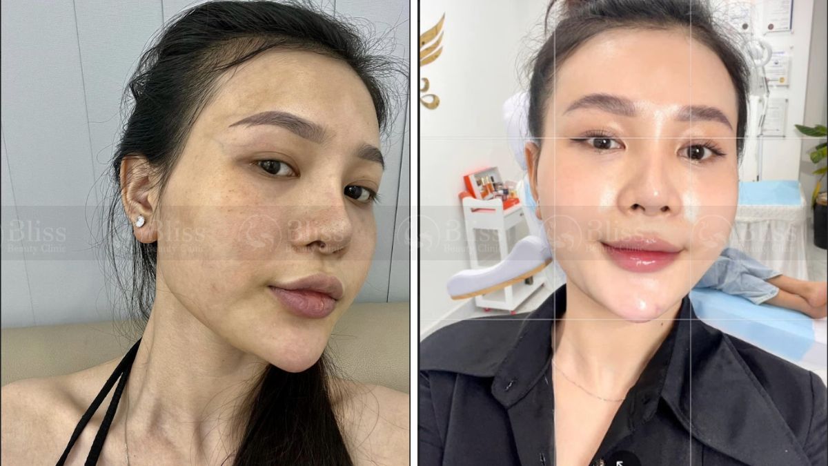 mesocell-extra-la-gi Tiêm meso