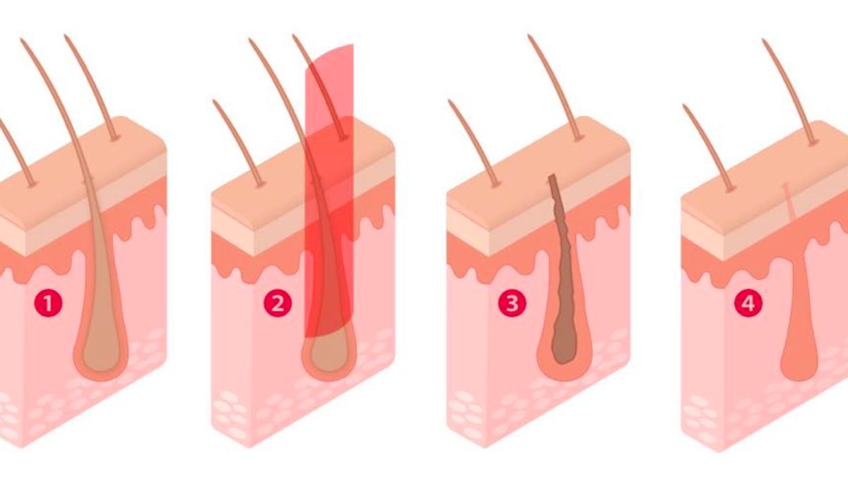 triet-long-chan-vinh-vien-cong-nghe-dpl-frey-2023