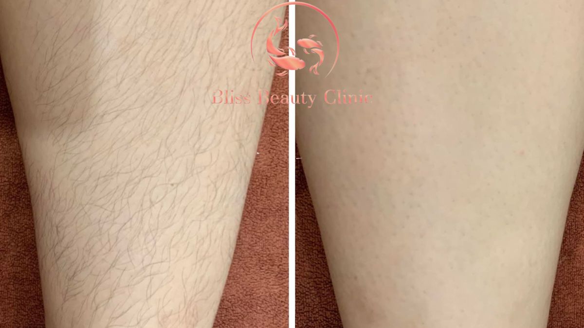 triet-long-chan-vinh-vien-cong-nghe-dpl-frey-2023