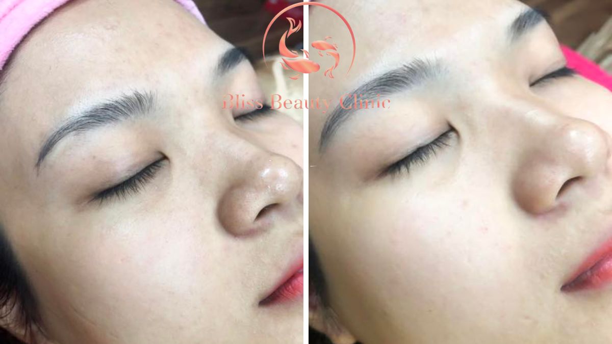 triet-long-mat-vinh-vien-cong-nghe-dpl-frey-2023