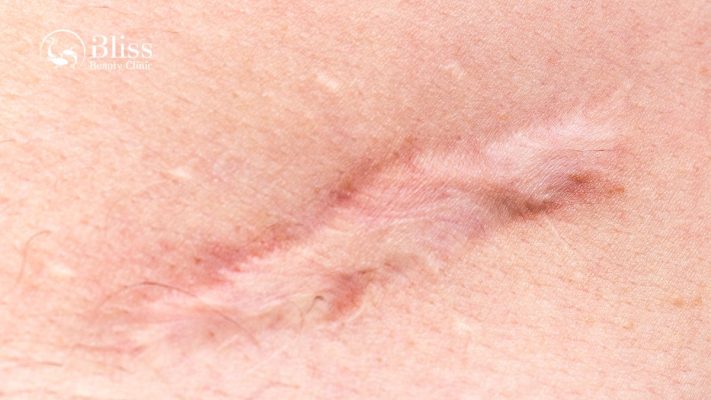 dieu-tri-seo-loi-hyper-scar-repair-3n1