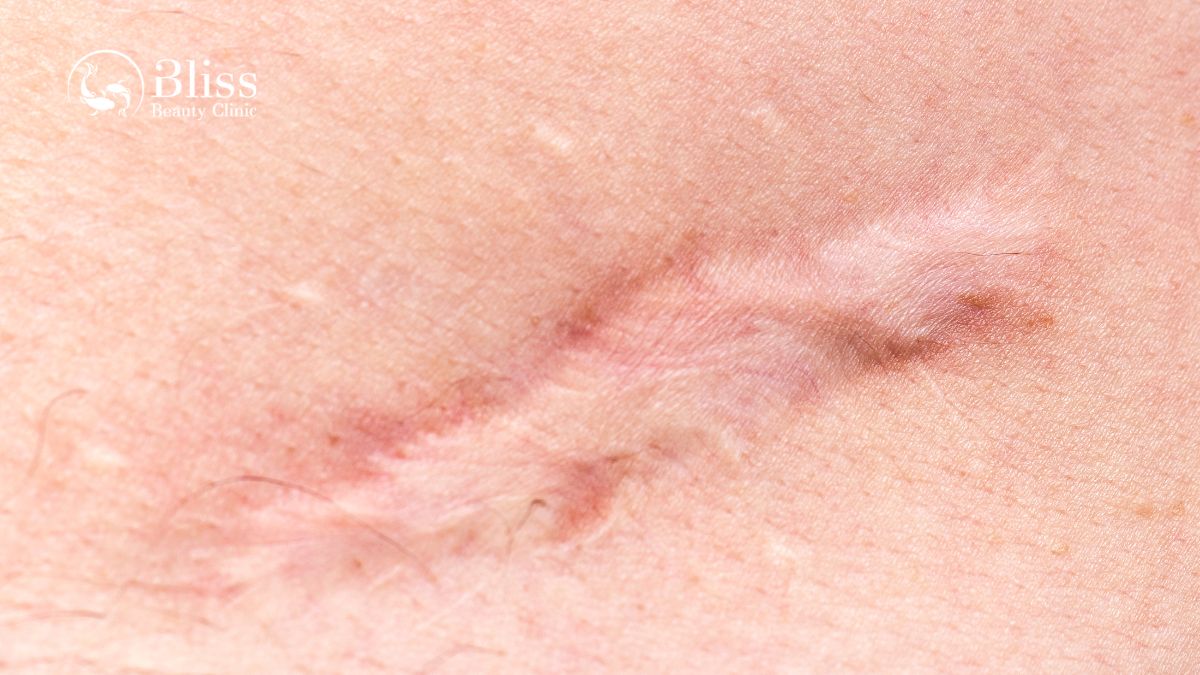 dieu-tri-seo-loi-hyper-scar-repair-3n1