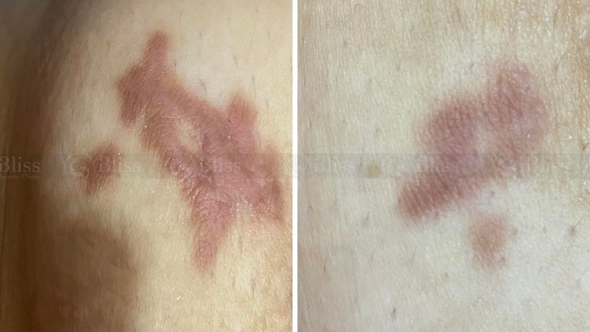 dieu-tri-seo-loi-hyper-scar-repair-3n1