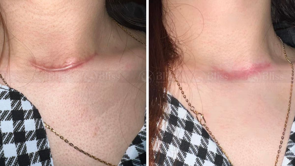 dieu-tri-seo-loi-hyper-scar-repair-3n1