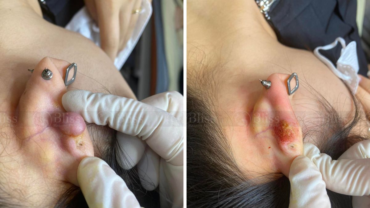 dieu-tri-seo-loi-hyper-scar-repair-3n1