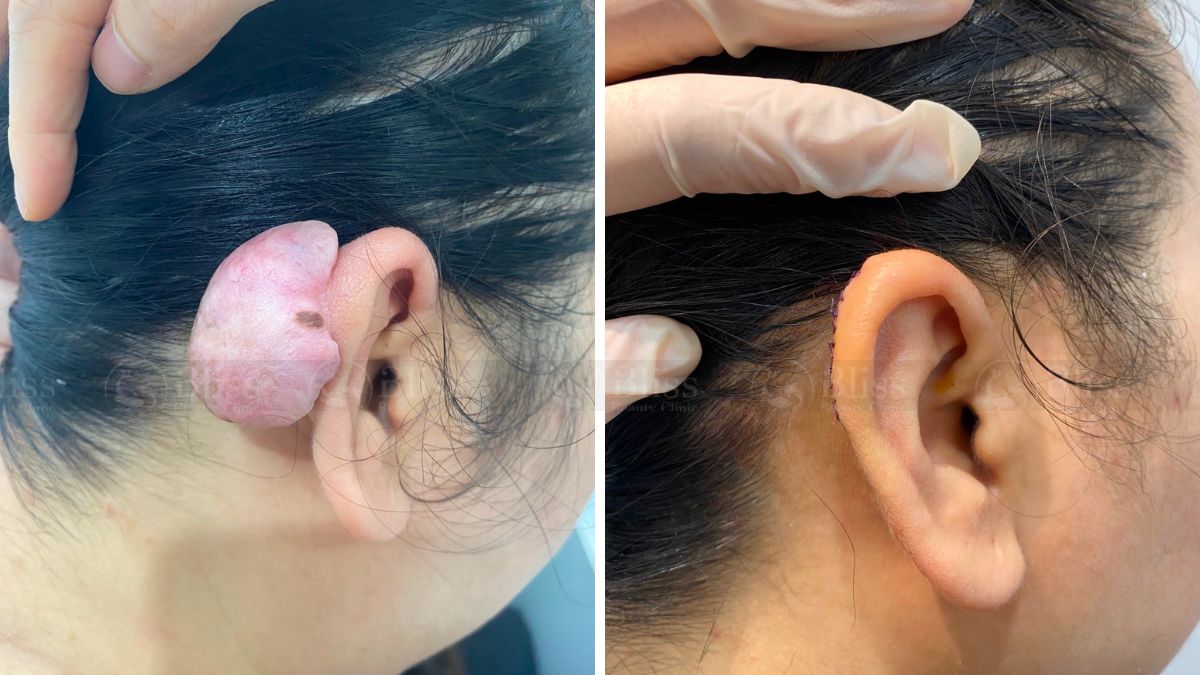 dieu-tri-seo-loi-hyper-scar-repair-3n1