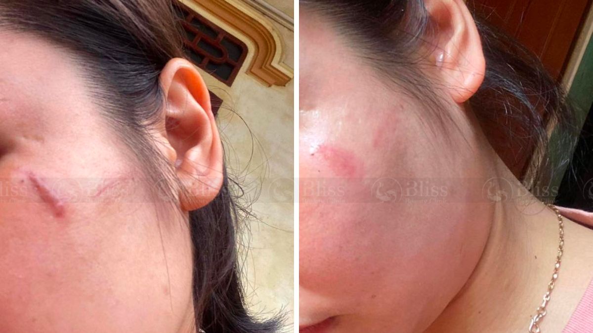 dieu-tri-seo-loi-hyper-scar-repair-3n1