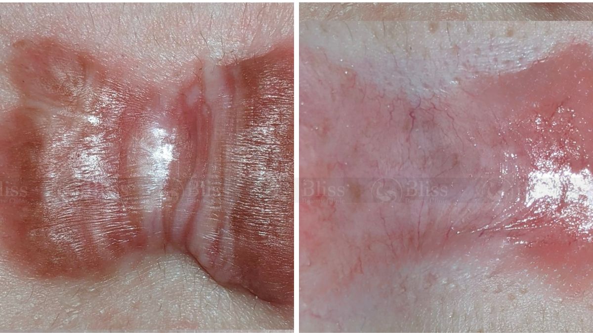 dieu-tri-seo-loi-hyper-scar-repair-3n1