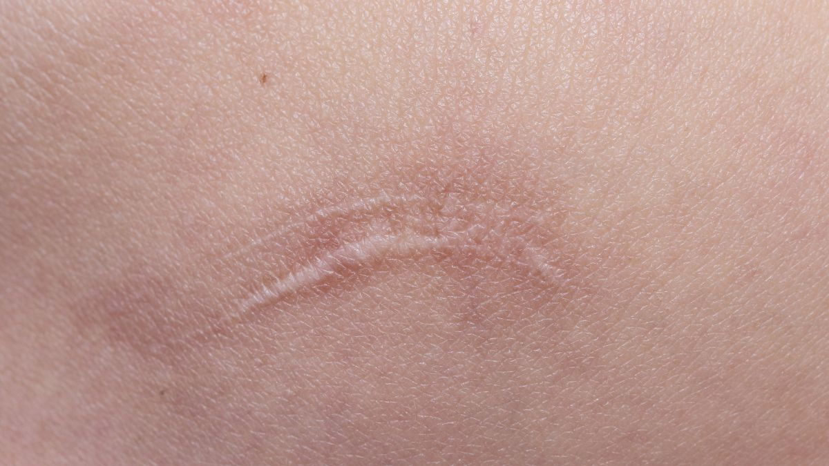 dieu-tri-seo-loi-hyper-scar-repair-3n1