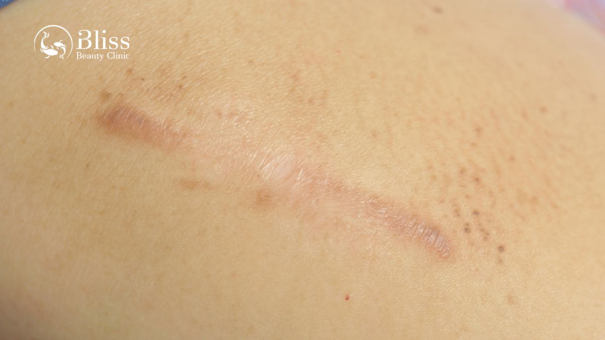 dieu-tri-seo-loi-hyper-scar-repair-3n1