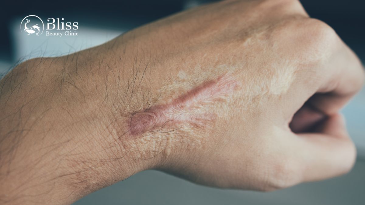 dieu-tri-seo-loi-hyper-scar-repair-3n1