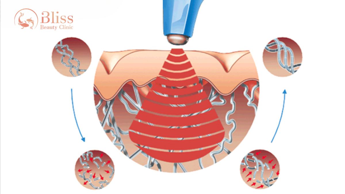 nang-co-tre-hoa-da-exilift-face