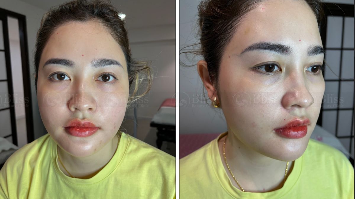 nang-co-tre-hoa-da-exilift-face