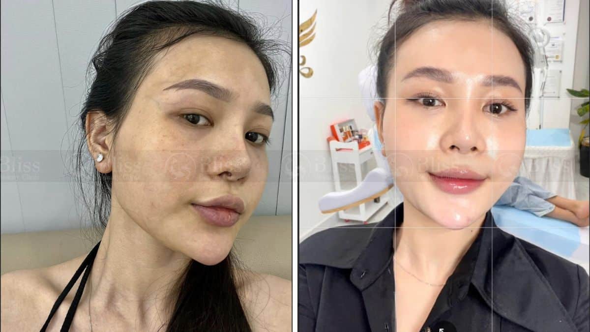 tiem-mesocell-extra-tri-nam