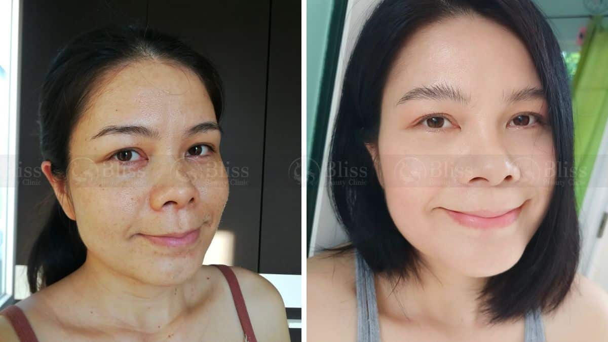 tiem-mesocell-extra-tri-nam