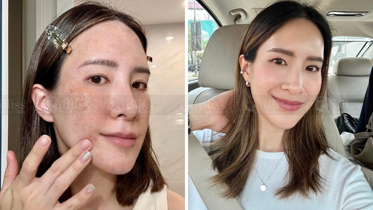 tiem-mesocell-extra-tri-nam