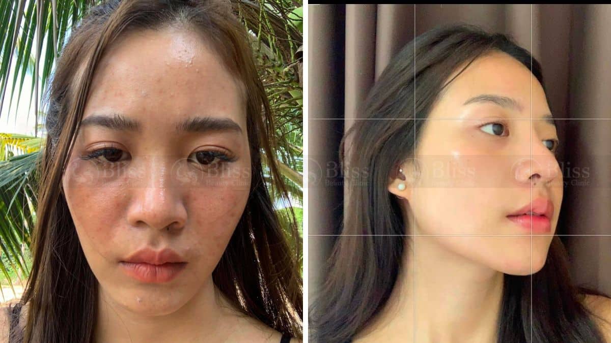 tiem-mesocell-extra-tri-nam