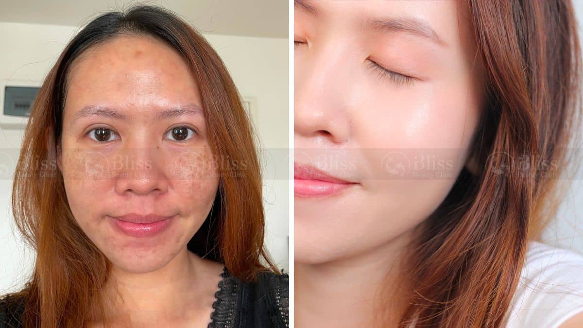 tiem-mesocell-extra-tri-nam