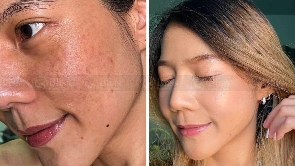 tiem-mesocell-extra-tri-nam