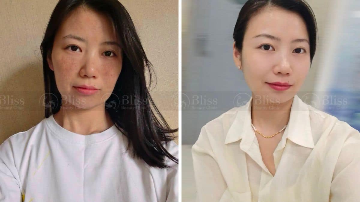 tiem-mesocell-extra-tri-nam