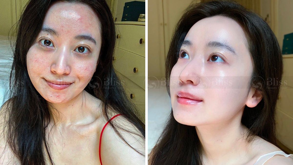 tiem-mesocell-extra-tri-mun-tham