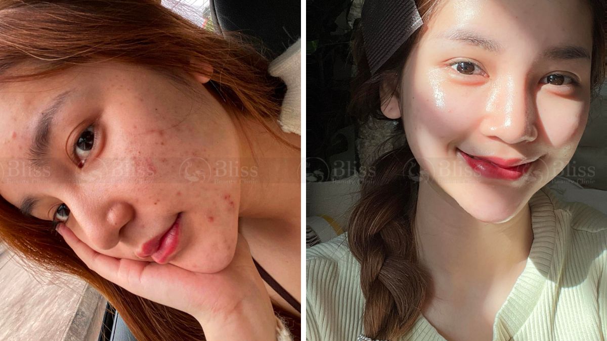 tiem-mesocell-extra-tri-mun-tham