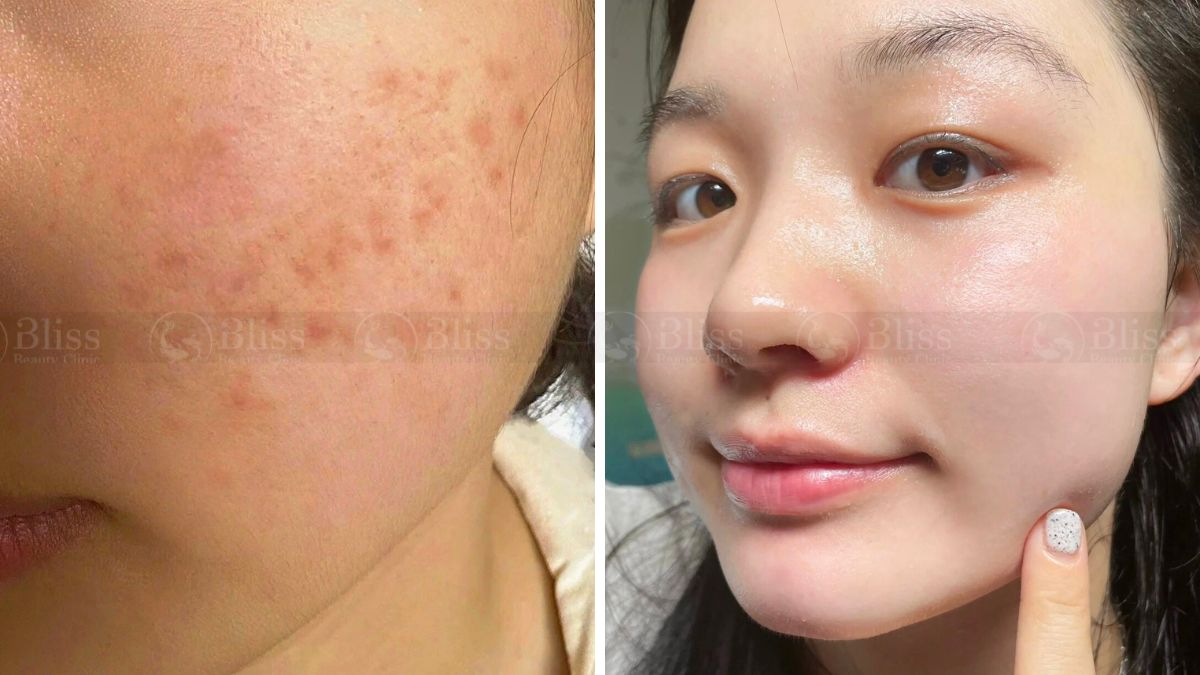 tiem-mesocell-extra-tri-mun-tham