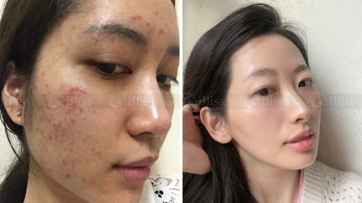 tiem-mesocell-extra-tri-mun-tham