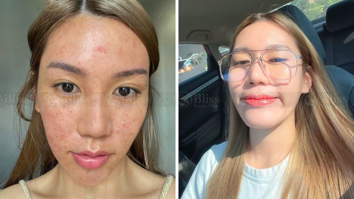 tiem-mesocell-extra-tri-mun-tham