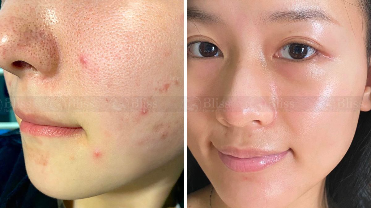 tiem-mesocell-extra-tri-mun-tham