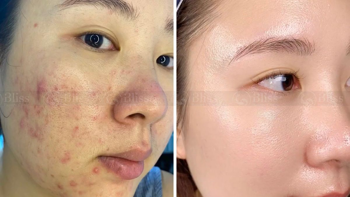 tiem-mesocell-extra-tri-mun-tham